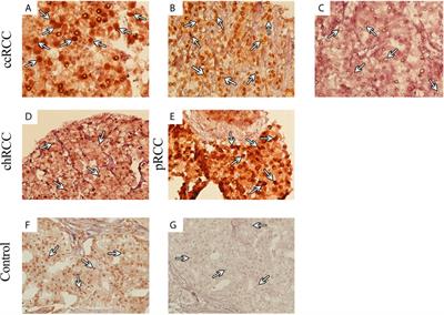 Frontiers | SMAD4 Expression in Renal Cell Carcinomas Correlates 